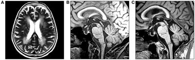 Older adult-onset Alexander disease with atypical clinicoradiological features: a case report